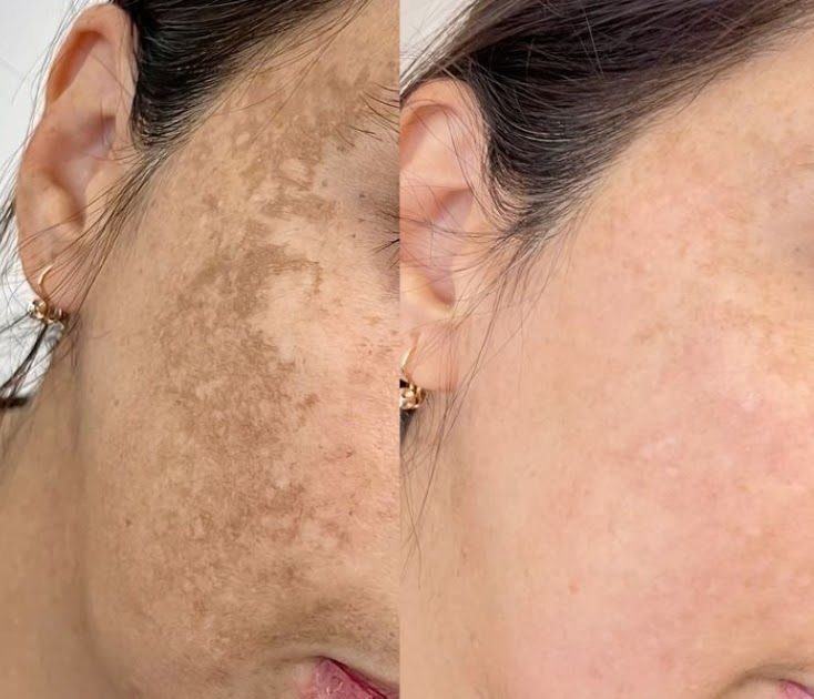 Pigmentation before and after IPL