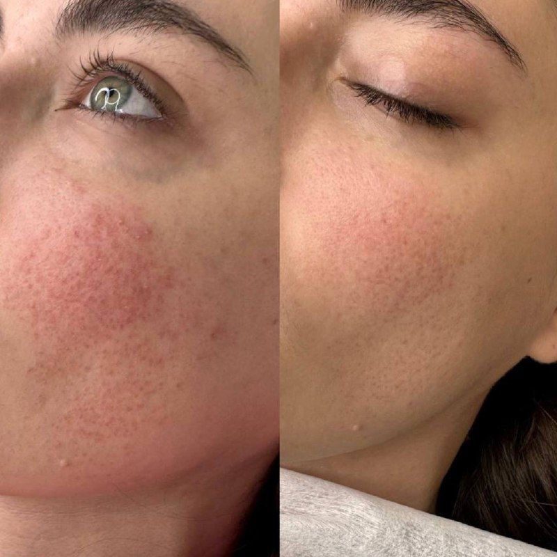 Rosacea before and after IPL