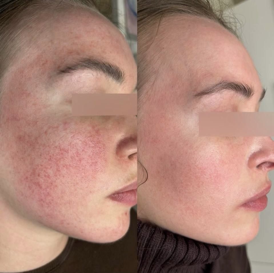 Rosacea before and after IPL