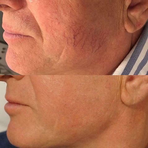 Facial vessels before and after IPL