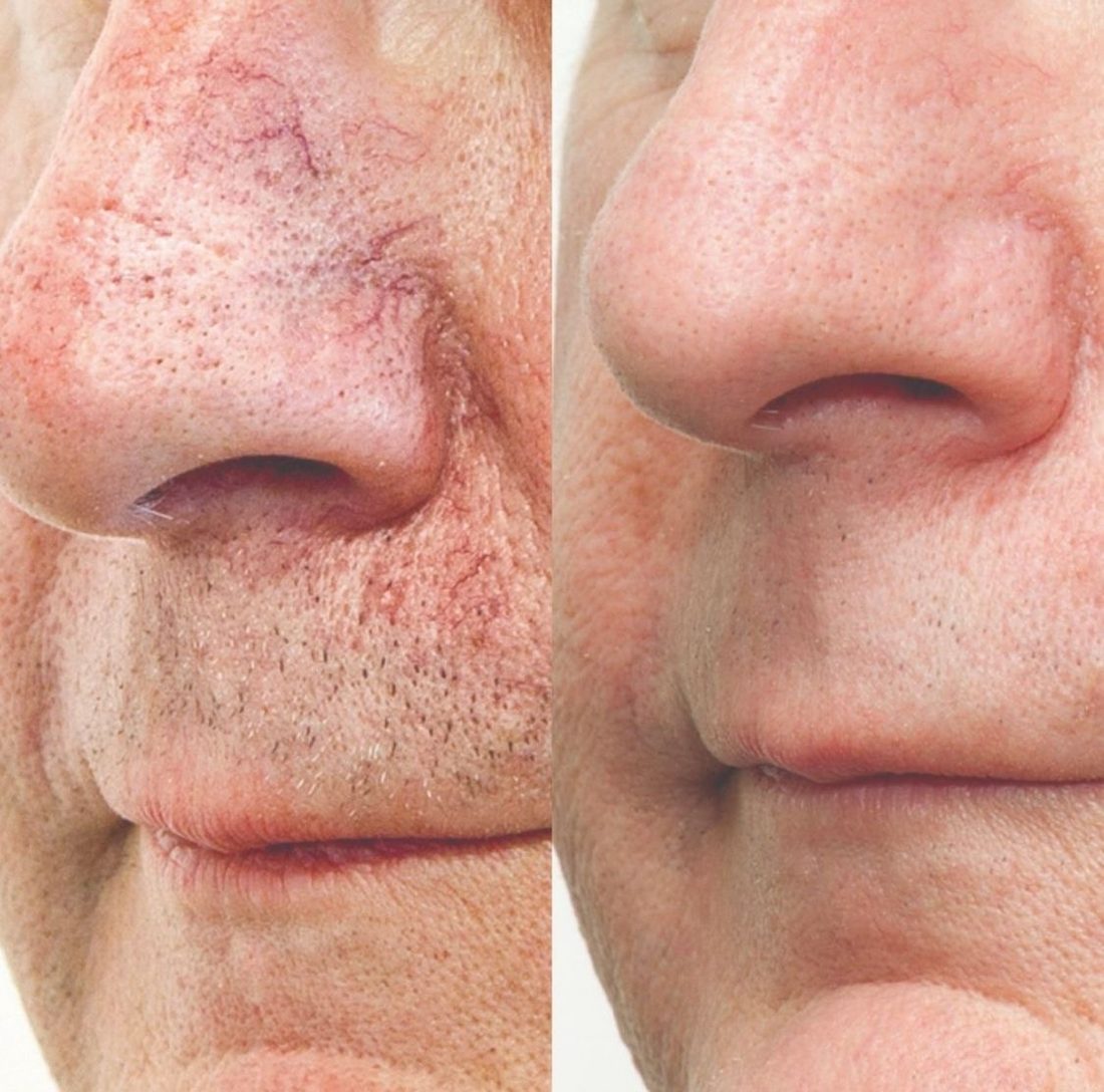 Broken capillaries on the nose before and after IPL