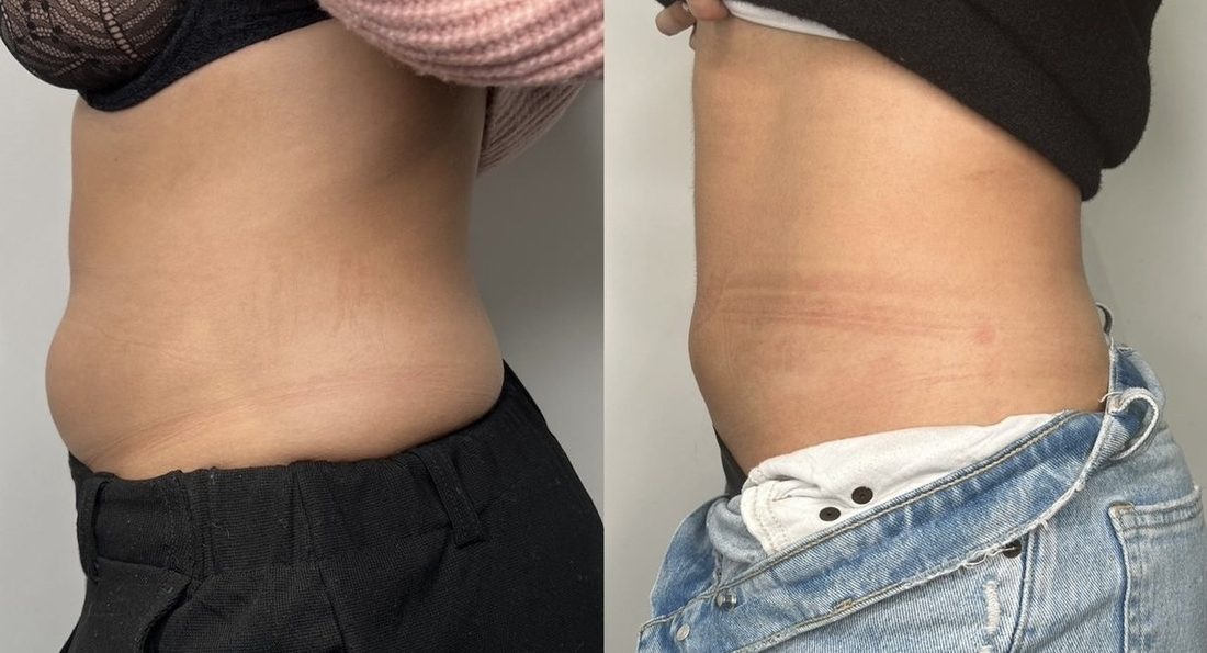 Abdomen before and after RF lifting