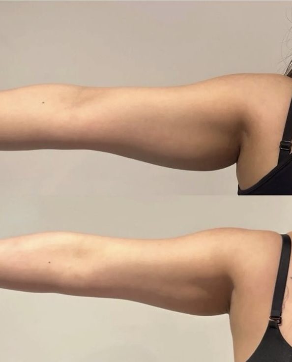 Arms before and after RF lifting