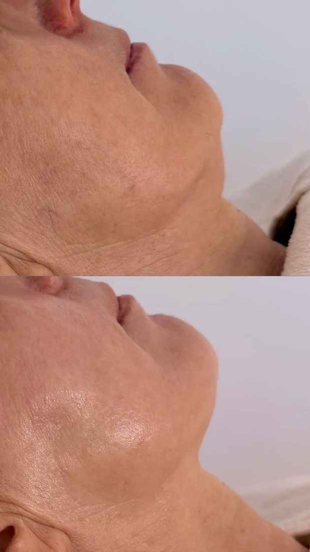 Eye area before and after RF lifting
