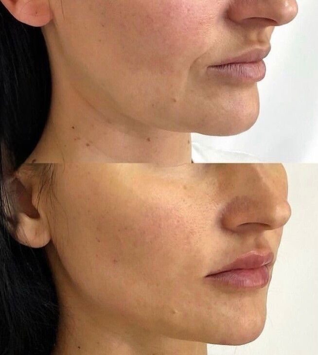 Under-eye before and after RF lifting