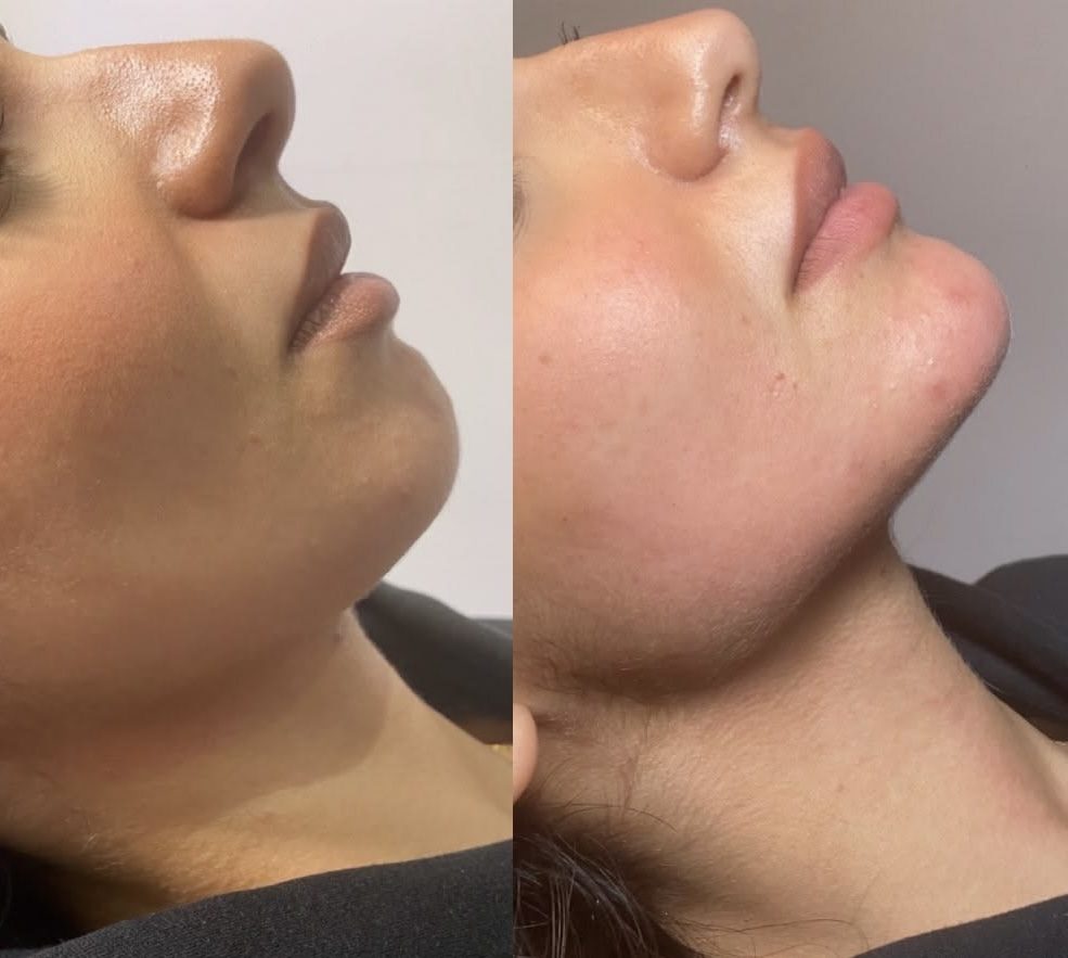 Collagen result