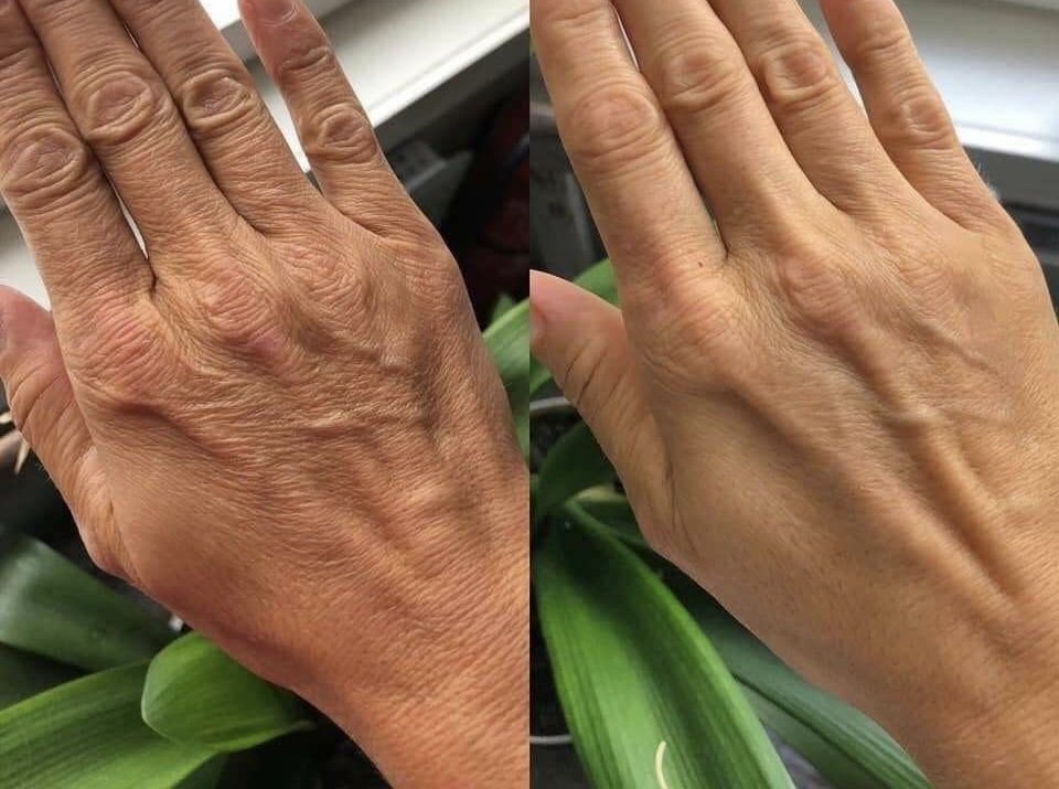 Hands rejuvenation before and after RF lifting