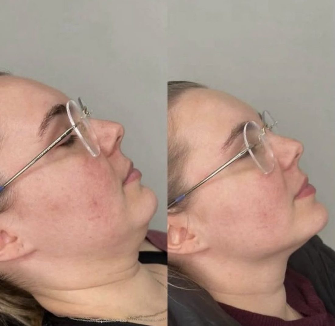 Jawline and neck before and after RF lifting